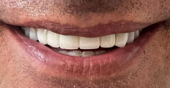 ایمپلنت دندان چیست؟ ایمپلنت فوری و دیجیتال چیست؟ + هزینه ها