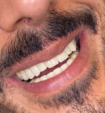 هزینه و قیمت ایمپلنت چقدر است؟