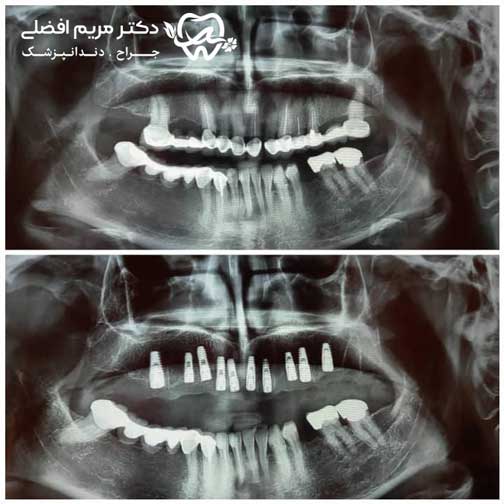 معایب و عوارض ایمپلنت دندان چیست؟