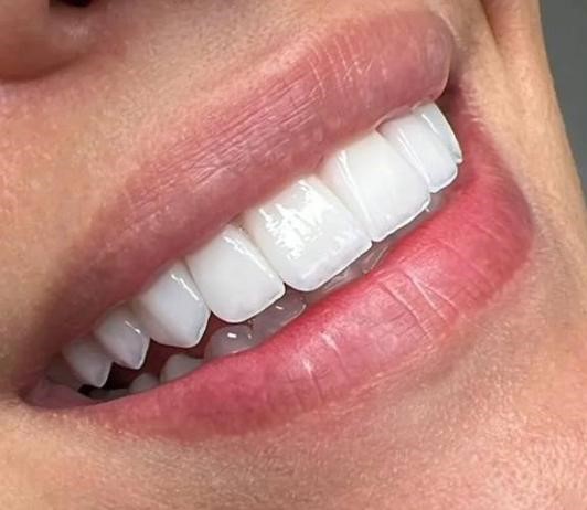 لمینیت دندان برای چه کسانی مناسب است؟!