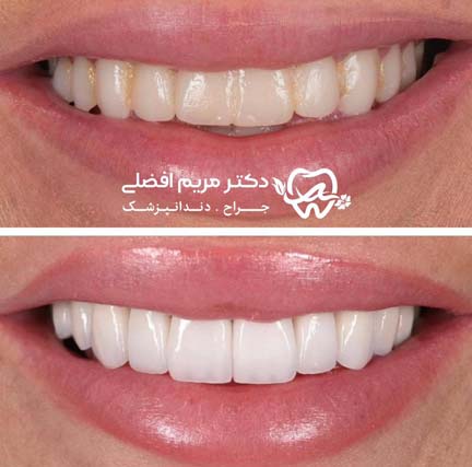 همه چیز در مورد لمینیت دندان (قیمت لمینیت، مزایا و معایب)