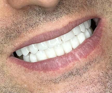 لمینیت دندان (Dental Veneers) چیست؟