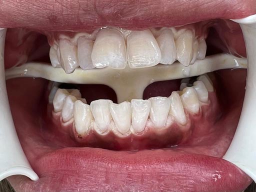 بلیچینگ دندان (Bleaching) چیست؟!