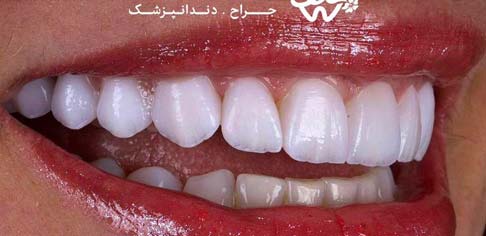 بعد لمینیت 2