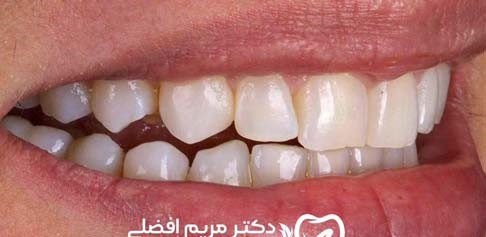 قبل لمینیت 2