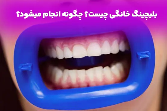 بلیچینگ خانگی