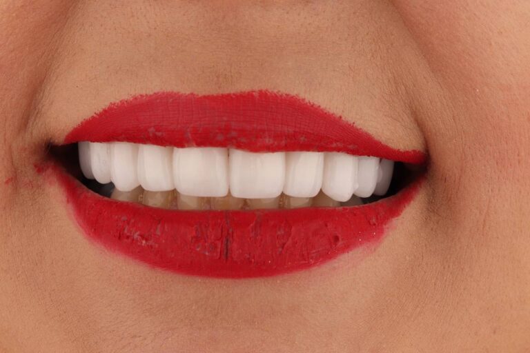 تفاوت لمینت و روکش