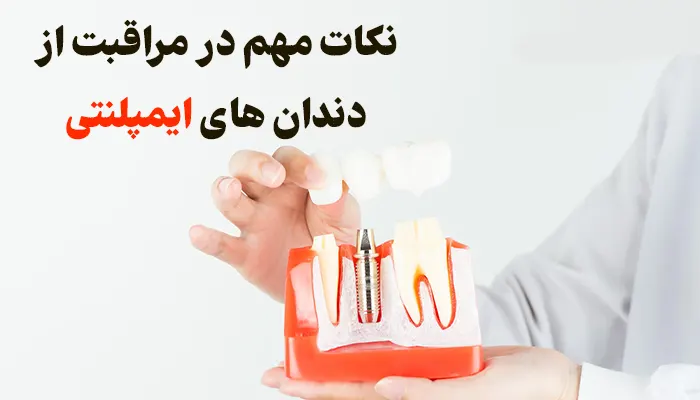 نکات مهم در مراقبت از دندان های ایمپلنتی