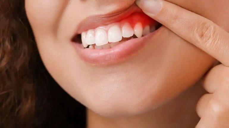 داروی گیاهی مفید برای کاهش التهاب لثه