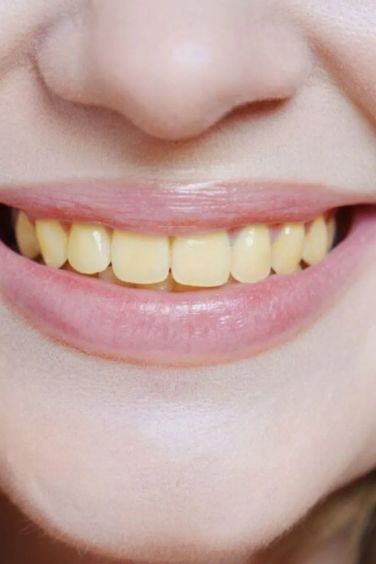 فواصل مناسب بین جلسات بلیچینگ دندان