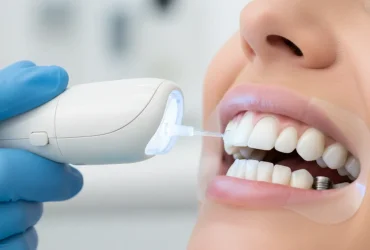 بلیچینگ روی ایمپلنت و لمینت