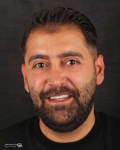 آیا لمینت دندان تعویض یا ترمیم میشود